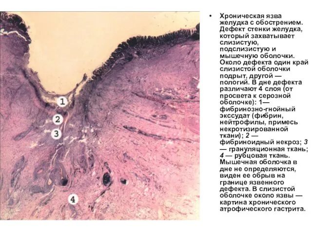Хроническая язва желудка с обострением. Дефект стенки желудка, который захватывает