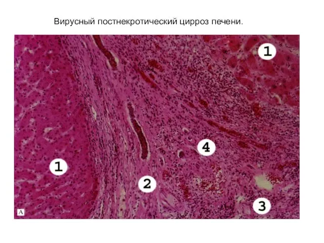 Вирусный постнекротический цирроз печени.