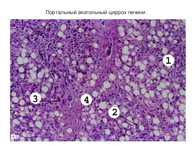 Портальный акогольный цирроз печени.