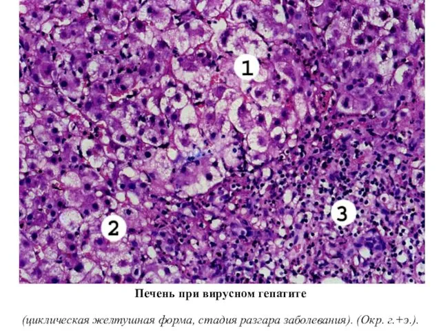 Печень при вирусном гепатите (циклическая желтушная форма, стадия разгара заболевания). (Окр. г.+э.).