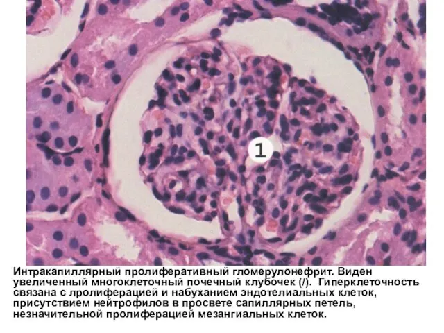 Интракапиллярный пролиферативный гломерулонефрит. Виден увеличенный многоклеточный почечный клубочек (/). Гиперклеточность