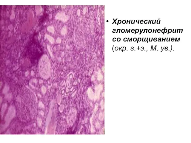 Хронический гломерулонефрит со сморщиванием (окр. г.+э., М. ув.).