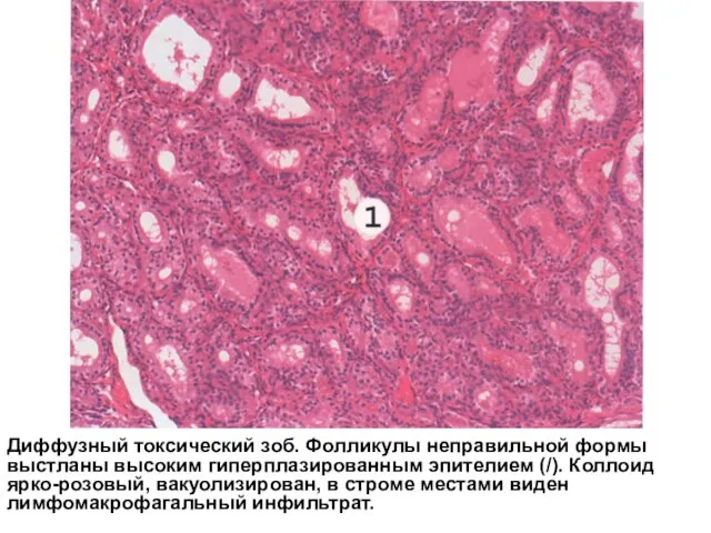 Диффузный токсический зоб. Фолликулы неправильной формы выстланы высоким гиперплазированным эпителием