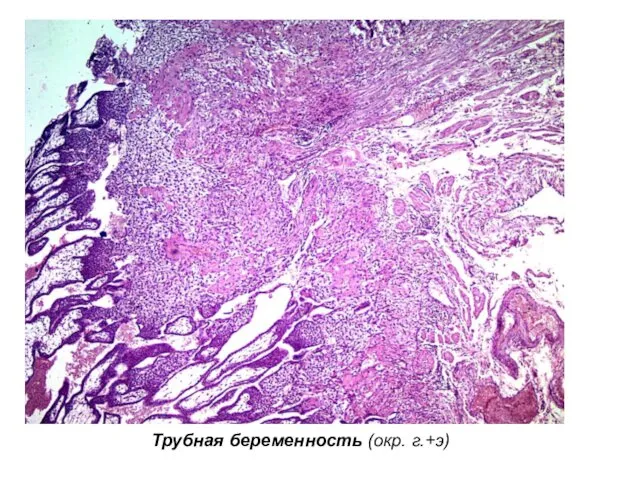 Трубная беременность (окр. г.+э)
