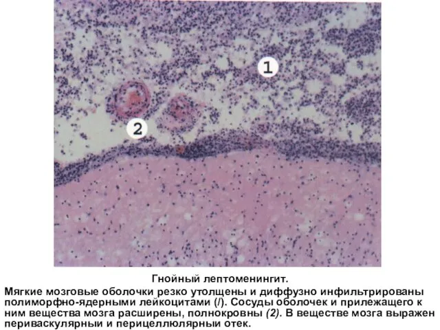 Гнойный лептоменингит. Мягкие мозговые оболочки резко утолщены и диффузно инфильтрированы