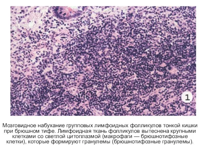 Мозговидное набухание групповых лимфоидных фолликулов тонкой кишки при брюшном тифе.