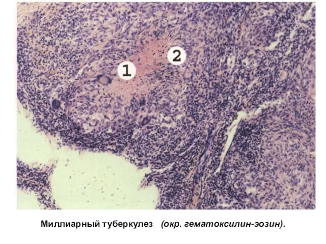 Миллиарный туберкулез (окр. гематоксилин-эозин).