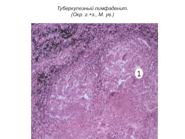 Туберкулезный лимфаденит. (Окр. г.+э., М. ув.)