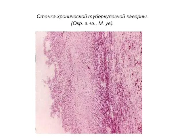 Стенка хронической туберкулезной каверны. (Окр. г.+э., М. ув).