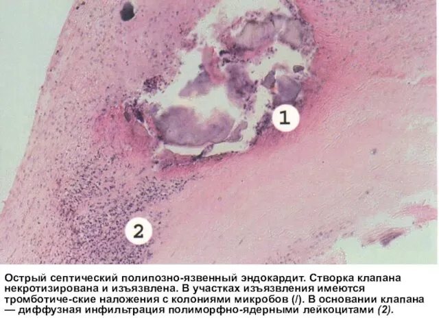 Острый септический полипозно-язвенный эндокардит. Створка клапана некротизирована и изъязвлена. В