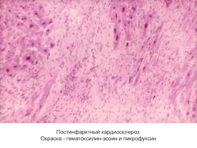 Постинфарктный кардиосклероз. Окраска - гематоксилин-эозин и пикрофуксин