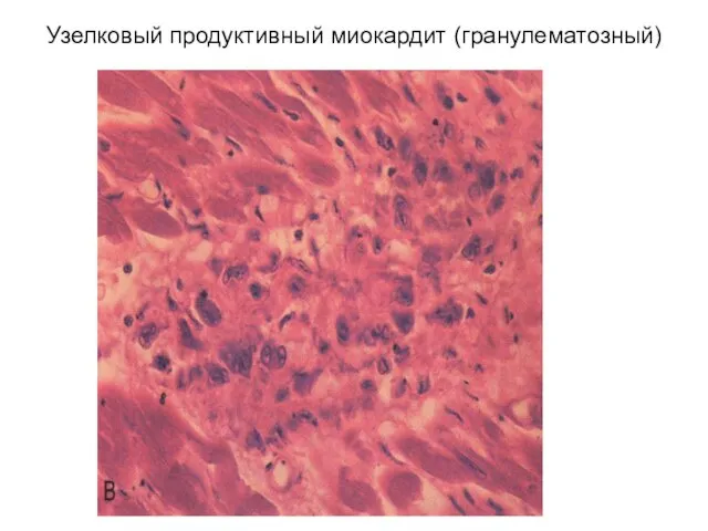 Узелковый продуктивный миокардит (гранулематозный)