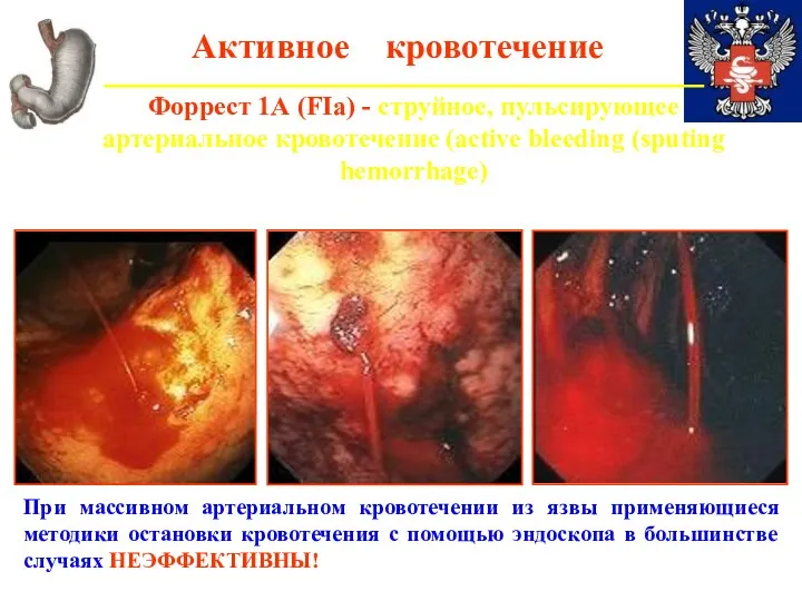 Активное кровотечение Форрест 1А (FIa) - струйное, пульсирующее артериальное кровотечение