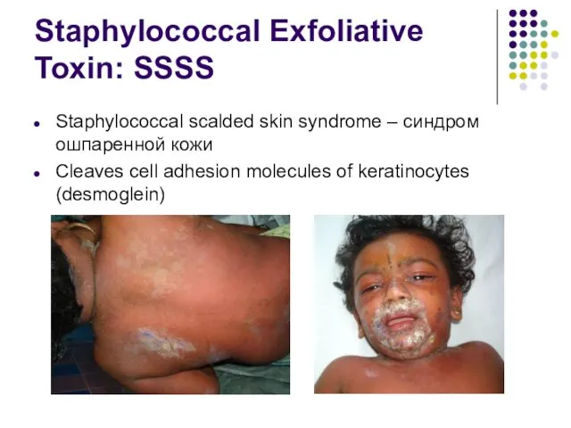 Staphylococcal Exfoliative Toxin: SSSS Staphylococcal scalded skin syndrome – синдром