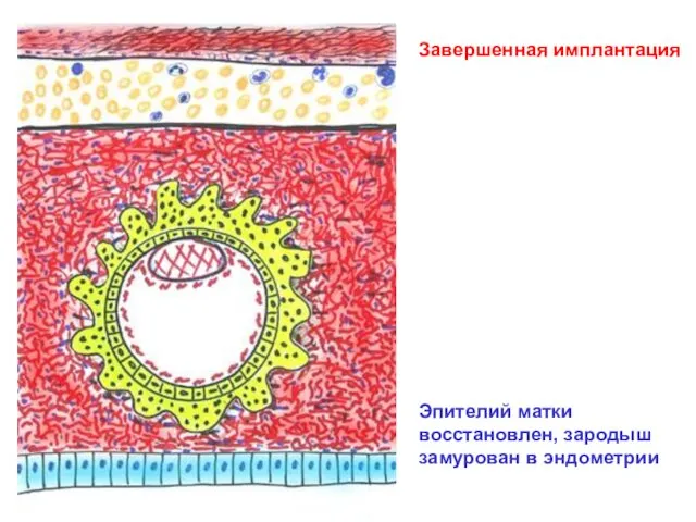 Завершенная имплантация Эпителий матки восстановлен, зародыш замурован в эндометрии