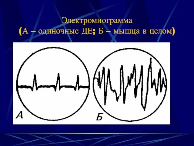 Электромиограмма (А – одиночные ДЕ; Б – мышца в целом)