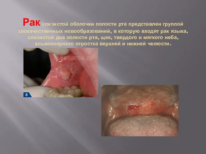 Рак слизистой оболочки полости рта представлен группой злокачественных новообразований, в
