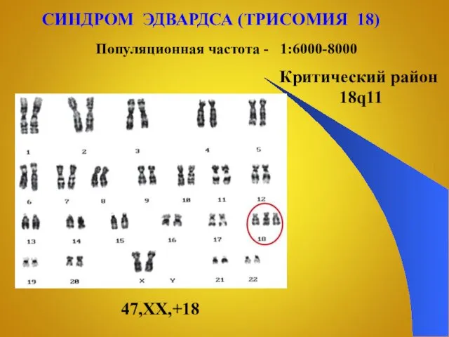 СИНДРОМ ЭДВАРДСА (ТРИСОМИЯ 18) 47,XX,+18 Популяционная частота - 1:6000-8000 Критический район 18q11