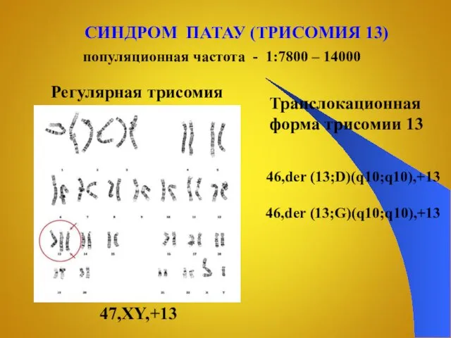 СИНДРОМ ПАТАУ (ТРИСОМИЯ 13) 47,XY,+13 популяционная частота - 1:7800 –