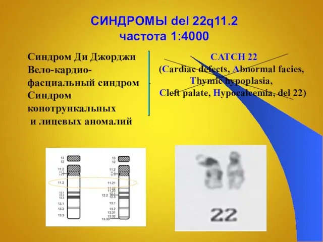 СИНДРОМЫ del 22q11.2 частота 1:4000