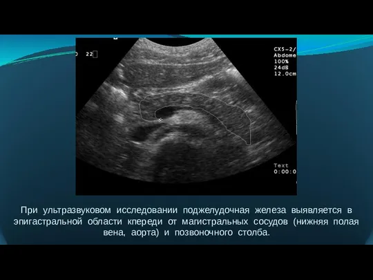 При ультразвуковом исследовании поджелудочная железа выявляется в эпигастральной области кпереди