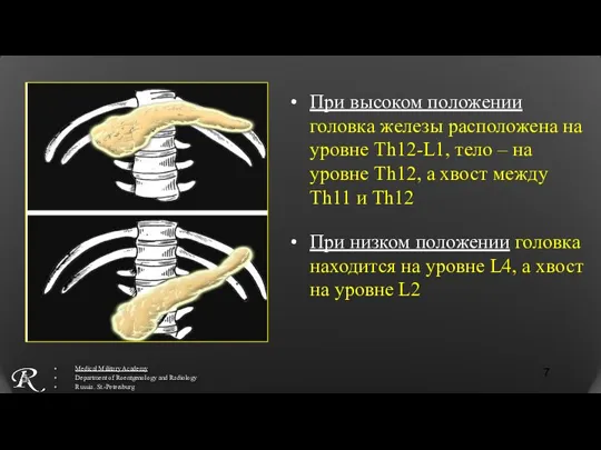 При высоком положении головка железы расположена на уровне Th12-L1, тело – на уровне