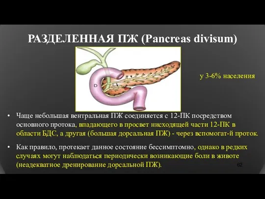 РАЗДЕЛЕННАЯ ПЖ (Pancreas divisum) Чаще небольшая вентральная ПЖ соединяется с 12-ПК посредством основного