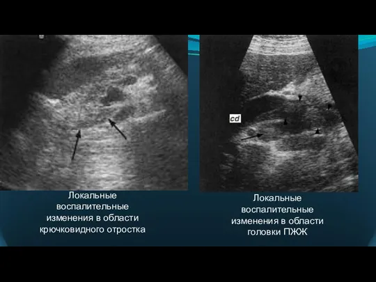 Локальные воспалительные изменения в области крючковидного отростка Локальные воспалительные изменения в области головки ПЖЖ