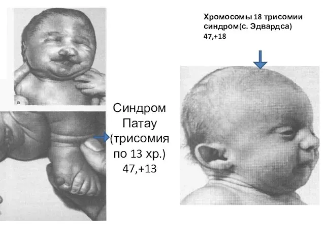 Синдром Патау (трисомия по 13 хр.) 47,+13 Хромосомы 18 трисомии синдром(с. Эдвардса) 47,+18