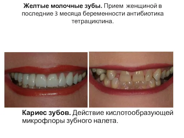 Желтые молочные зубы. Прием женщиной в последние 3 месяца беременности