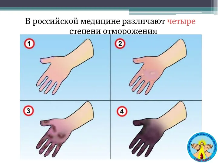 В российской медицине различают четыре степени отморожения