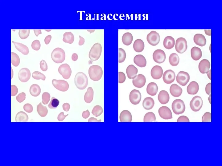 Талассемия