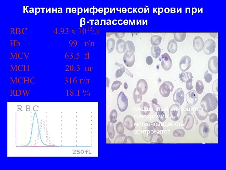 Картина периферической крови при β-талассемии RBC 4.93 x 1012/л Hb