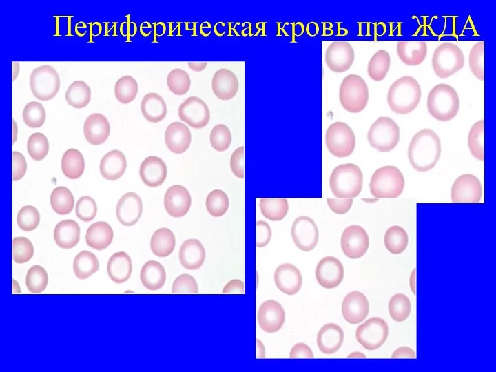 Периферическая кровь при ЖДА