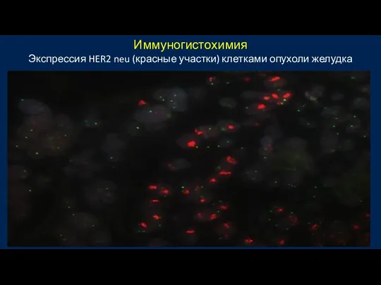 Иммуногистохимия Экспрессия HER2 neu (красные участки) клетками опухоли желудка