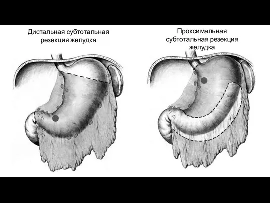 Дистальная субтотальная резекция желудка Проксимальная субтотальная резекция желудка
