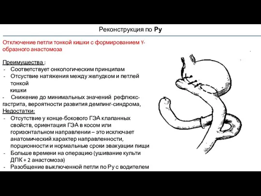 Реконструкция по Ру Отключение петли тонкой кишки с формированием Y-образного