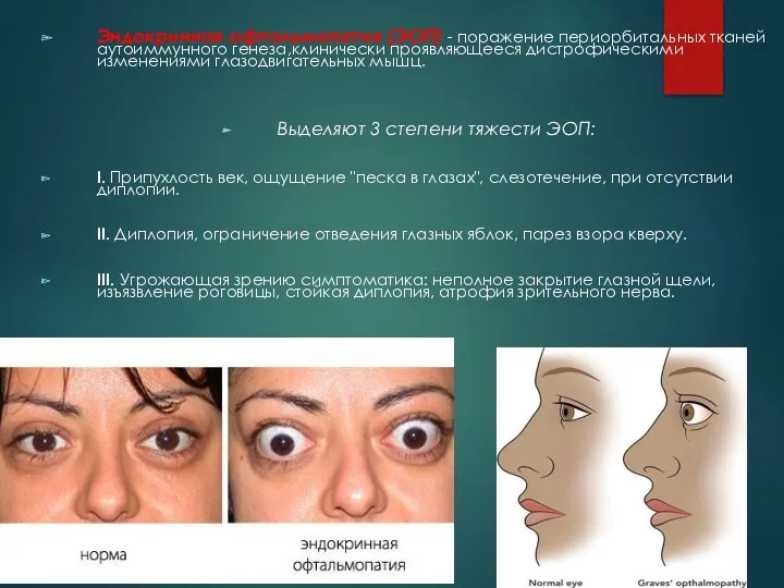 Эндокринная офтальмопатия (ЭОП) - поражение периорбитальных тканей аутоиммунного генеза,клинически проявляющееся