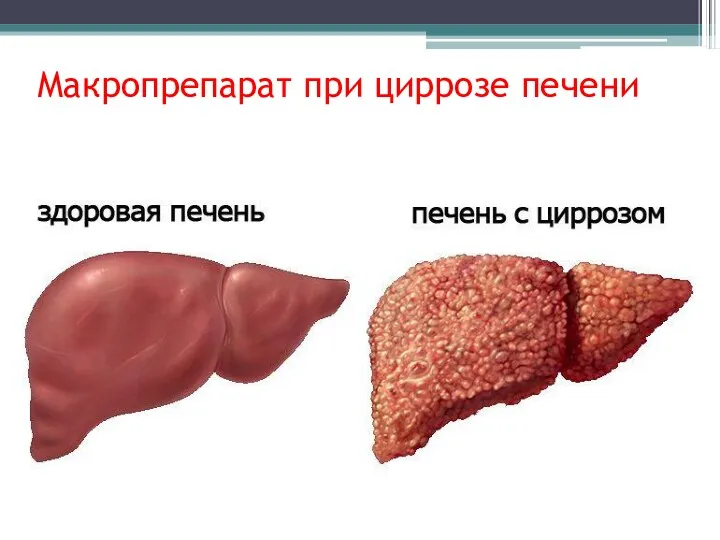 Макропрепарат при циррозе печени