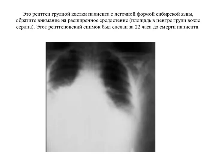 Это рентген грудной клетки пациента с легочной формой сибирской язвы, обратите внимание на