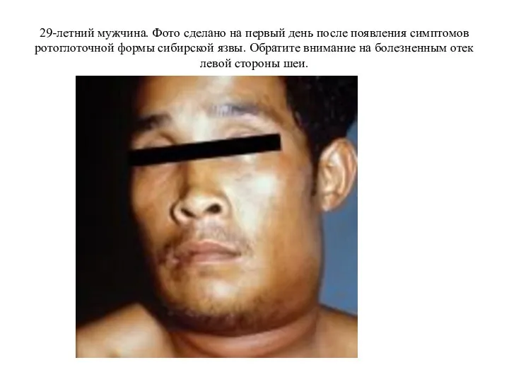29-летний мужчина. Фото сделано на первый день после появления симптомов ротоглоточной формы сибирской