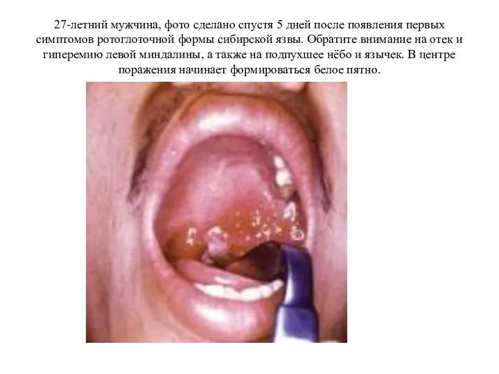 27-летний мужчина, фото сделано спустя 5 дней после появления первых симптомов ротоглоточной формы