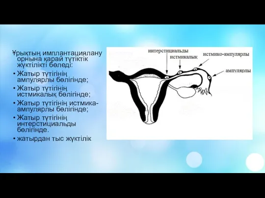 Ұрықтың имплантациялану орнына қарай түтіктік жүктілікті бөледі: Жатыр түтігінің ампулярлы