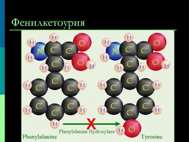 Фенилкетоурия