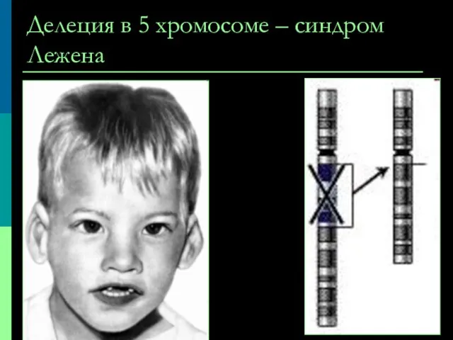 Делеция в 5 хромосоме – синдром Лежена