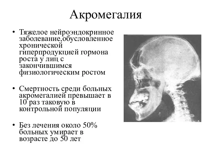 Акромегалия Тяжелое нейроэндокринное заболевание,обусловленное хронической гиперпродукцией гормона роста у лиц