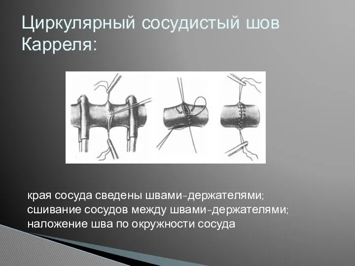 Циркулярный сосудистый шов Карреля: края сосуда сведены швами-держателями; сшивание сосудов