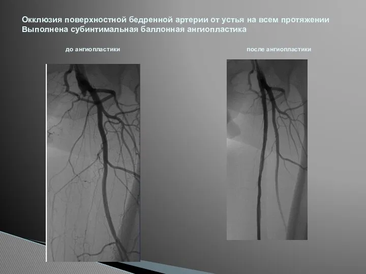 Окклюзия поверхностной бедренной артерии от устья на всем протяжении Выполнена