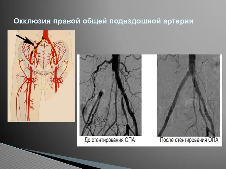 Окклюзия правой общей подвздошной артерии