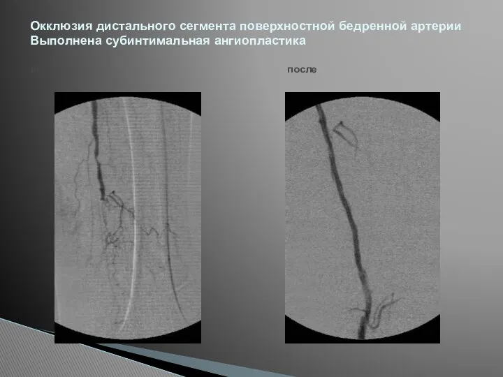 Окклюзия дистального сегмента поверхностной бедренной артерии Выполнена субинтимальная ангиопластика до после